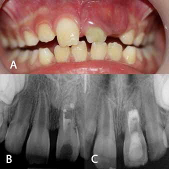 (A) Photograph of the buccal swelling around tooth
no: 21. (B) periapical radiograph revealed increase of
root length and dentinal wall thickness, (C) periapical
radiograph after repeating MTA placement