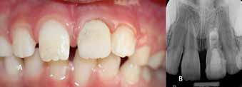 17-month recall of tooth no: 21. (A) Clinical
photograph, (B) Periapical radiograph
