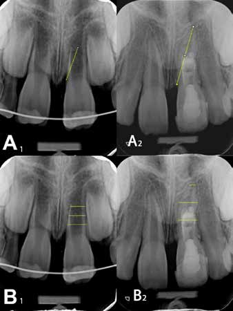 Linear measurements in mathematically aligned
radiographic pairs, using TurboReg analysis. (A1)
Root length before treatment, (A2) root length after
final follow up, (B1) dentinal wall thickness before
treatment, (B2) dentinal wall thickness after follow up.