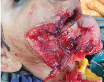 Pre-operative image showing the wound after intraoral
explosion of firecracker.