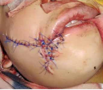 Primary closure after complete debridement under
general anesthesia.