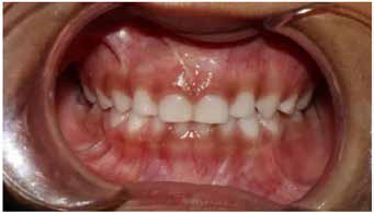 Intraoral frontal view.