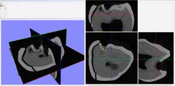 Removing of pollution and image artifacts with
Dataviewer 1.5.0 64 bit (SkyScan, Kontich, Belgium)
program