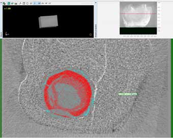 CTAn 1.15.4.0 (Skyscan, Kontich, Belgium) software,
isolation of caries lesion from the dentin tissue .