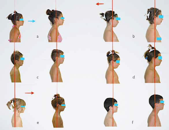Improvement of the head position, with the VLL passing through the tragus of the ear, in six patients
(a-b-c-d-e-f) at T0 and T1.