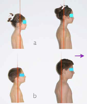 Hyper-correction of the head position in two patients
(a-b). Both had a correct head position at T0 and
showed a moderately forward head position at T1.