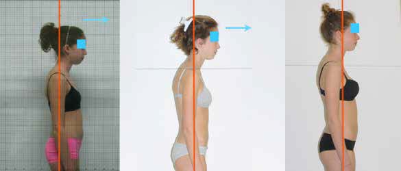 Temporary hyper-correction of the head position at T1 but correct head position at the end of the
growth.