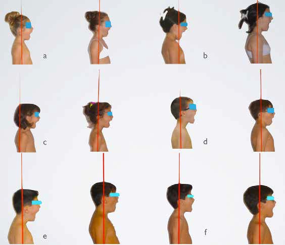 Improvement of the head position (evidenced with the “open mouth test”) in six patients (a-b-c-de-
f) at T0 and T1.
