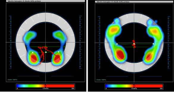 Normalization of the typology of podalic support: correction of a cavus foot (on the left) into a
normal foot (on the right) after the therapy.