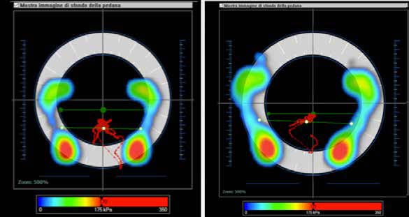 Amelioration of podalic support: change of a marked cavus foot (on the left) into a less severe cavus
foot (on the right).