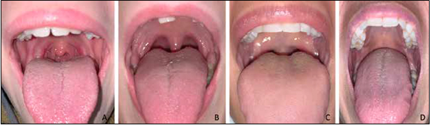 A) Mallampati Class 1 with visualization of the patient’s soft palate, fauces, uvula and tonsillar pillars. B)
Mallampati Class 2 with visualization of the patient’s soft palate, fauces and uvula. C) Mallampati Class 3 with
visualization of the patient’s soft palate and base of the uvula. D) Mallampati Class 4 with visibility of the patient’s
hard palate alone.