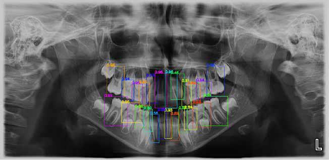 Results of permanent and primary tooth detection and numbering in YOLO V4. Detection confidence score is provided
on top of each detected tooth.