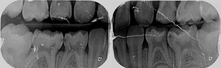 Intraoral radiographs.