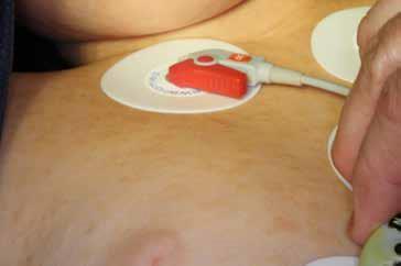 Extended maculopapular lesions -characteristic of mastocytosis- over the girl’s trunk and neck.