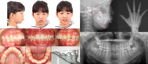 Pretreatment (T1) facial and intraoral photographs, digital model, and radiographs.