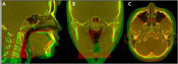 3-dimensional superimpositions of pretreatment (T1, orange) and 39 month-posttreatment (T5,
green). (A) Sagittal view. (B) Coronal view. (C) Axial view.
