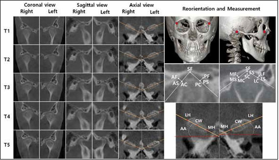 Reorientation of cone-beam computed tomography (CBCT) images (right and left fronto-zygomatic
points, right porion, and right orbitale) and measurements of the temporomandibular joint spaces,
condylar axial angle (AA), and condylar width (CW) (T1-T2-T3-T4-T5). T1, Pretreatment; T2, 4
months of active plate treatment and 9 months of Twin Block treatment; T3, 13 months after Twin
Block treatment; T4, after 17 months of fixed orthodontic treatment; T5, 39 month-posttreatment.
SF, superior fossa; AF, anterior fossa; PF, posterior fossa; MF, medial fossa; LF, lateral fossa; AS,
anterior space; SS, superior space; PS, posterior space; MS, medial space; LS, lateral space; AC,
anterior condyle; SC, superior condyle; PC, posterior condyle; MC, medial condyle; LC, lateral
condyle, MH, medial head; LH, lateral head; CW, the distance between MH and LH; AA, the angle
between MH-LH line and coronal plane.