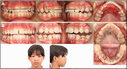 Treatment progress. (A) Intraoral photographs of the active plate with
expansion screw. (B) Facial and intraoral photographs of Twin Block
appliance with an expansion screw.