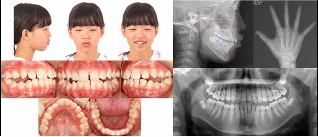 Facial and intraoral photographs and radiographs after 4 months of the active plate and 9 months of Twin Block
appliance treatment (T2).