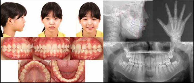 Facial and intraoral photographs and radiographs after 13 months of Twin Block treatment with a modified maxillary
Hawley retainer (T3).