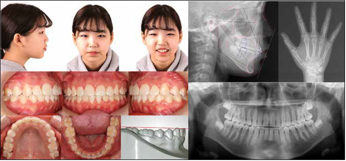 Posttreatment (T4) facial and intraoral photographs, digital model, and radiographs after 17 months of fixed orthodontic
treatment.