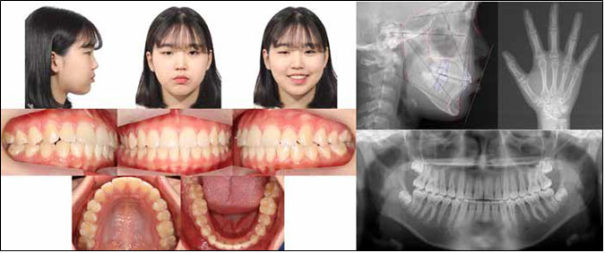 Facial and intraoral photographs and radiographs at 39 month-posttreatment (T5).