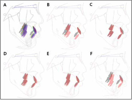 Cephalometric superimpositions. (A) T1-T2-T3-T4-T5. (B) T1-T2. (C) T2-T3. (D) T3-T4. (E) T4-T5. (F) T1-T5. T1,
Pretreatment; T2, 4 months of active plate treatment and 9 months of Twin Block treatment; T3, 13 months
after Twin Block treatment; T4, after 17 months of fixed orthodontic treatment; T5, 39 month-posttreatment.