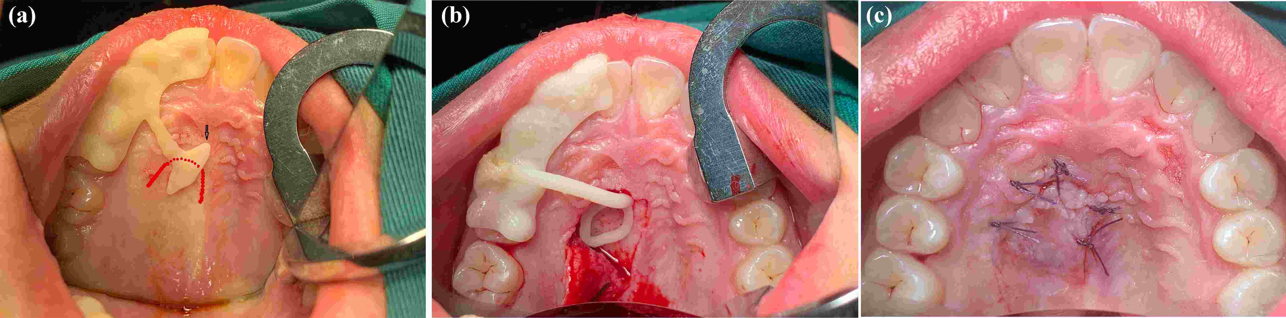 Intraoperative application. a: Arrow shows the locating guide, and red line shows the incision design; b: 
Mucoperiosteal flap was elevated and fenestration template was mounted; c: 
Primary wound closure with 4-0 absorbable suture.