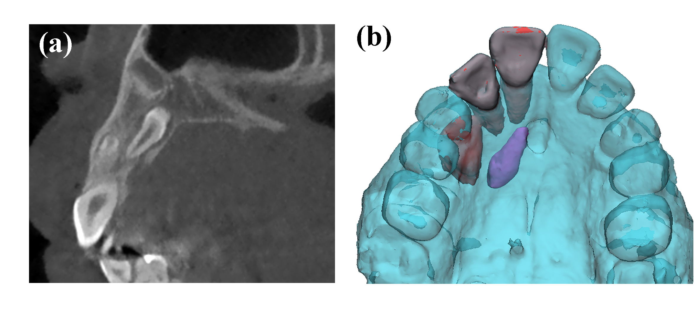Anatomical location of the 
SNT. a: Sagittal view of the impacted SNT; b: Three dimensional relationship 
between the SNT and adjacent teeth and incisive foramina.