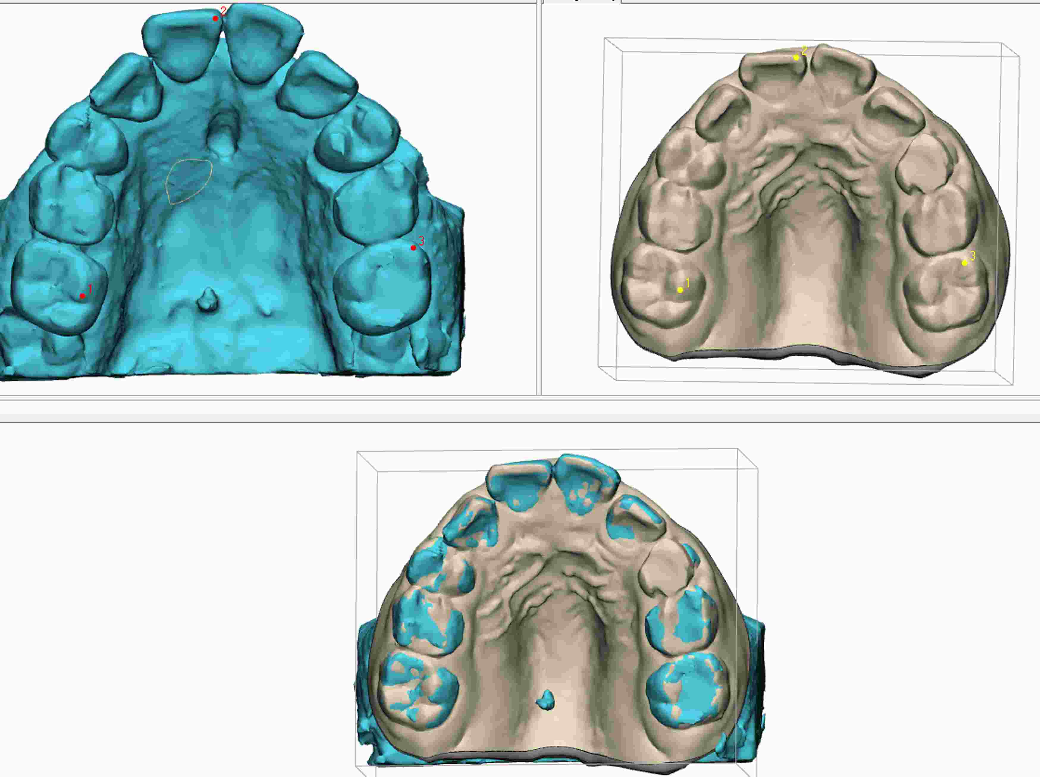 Data fusion. Superimposition of the CBCT image and intraoral scan.