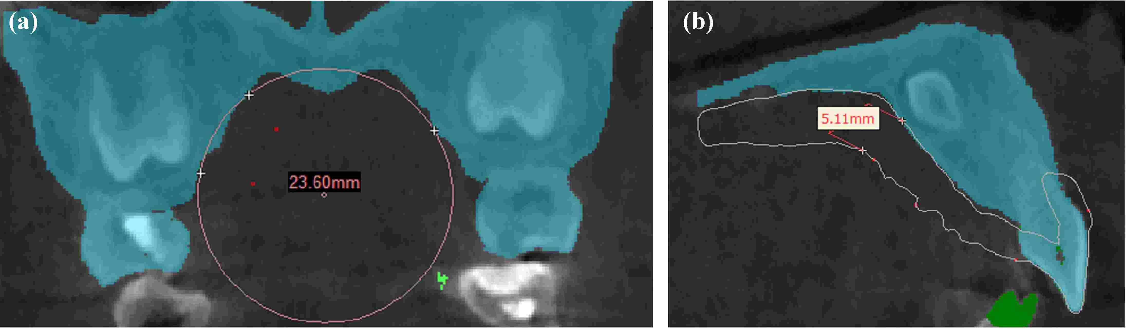 Anatomical features of the 
palate. a: Radius of curvature of palatal vault was 2.36 cm; b: Thickness of 
mucoperiosteal flap was 5.11 mm.