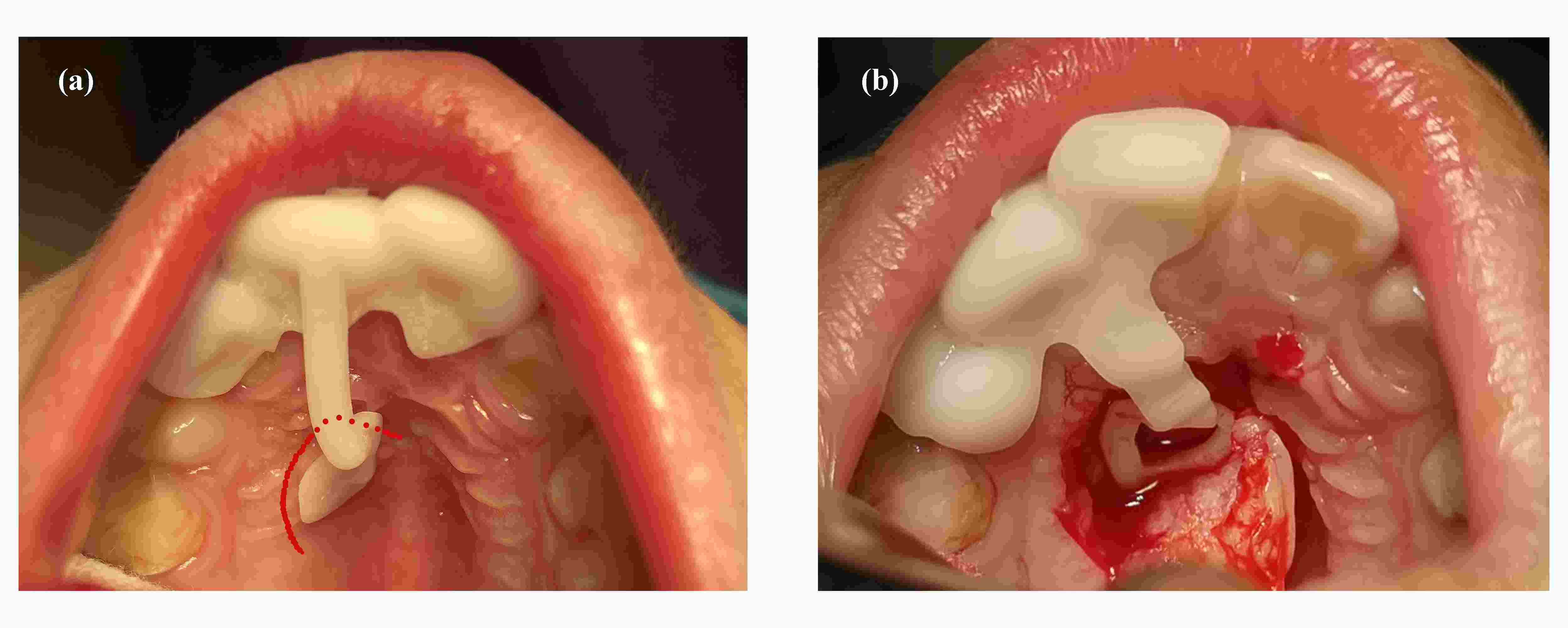 Intraoperative application. a: Semi-lunar mucosal incision (red line) was designed with the indication of 
locating guide; b: Mucoperiosteal flap was elevated, and large amount of 
submucosal tissue was noticed.