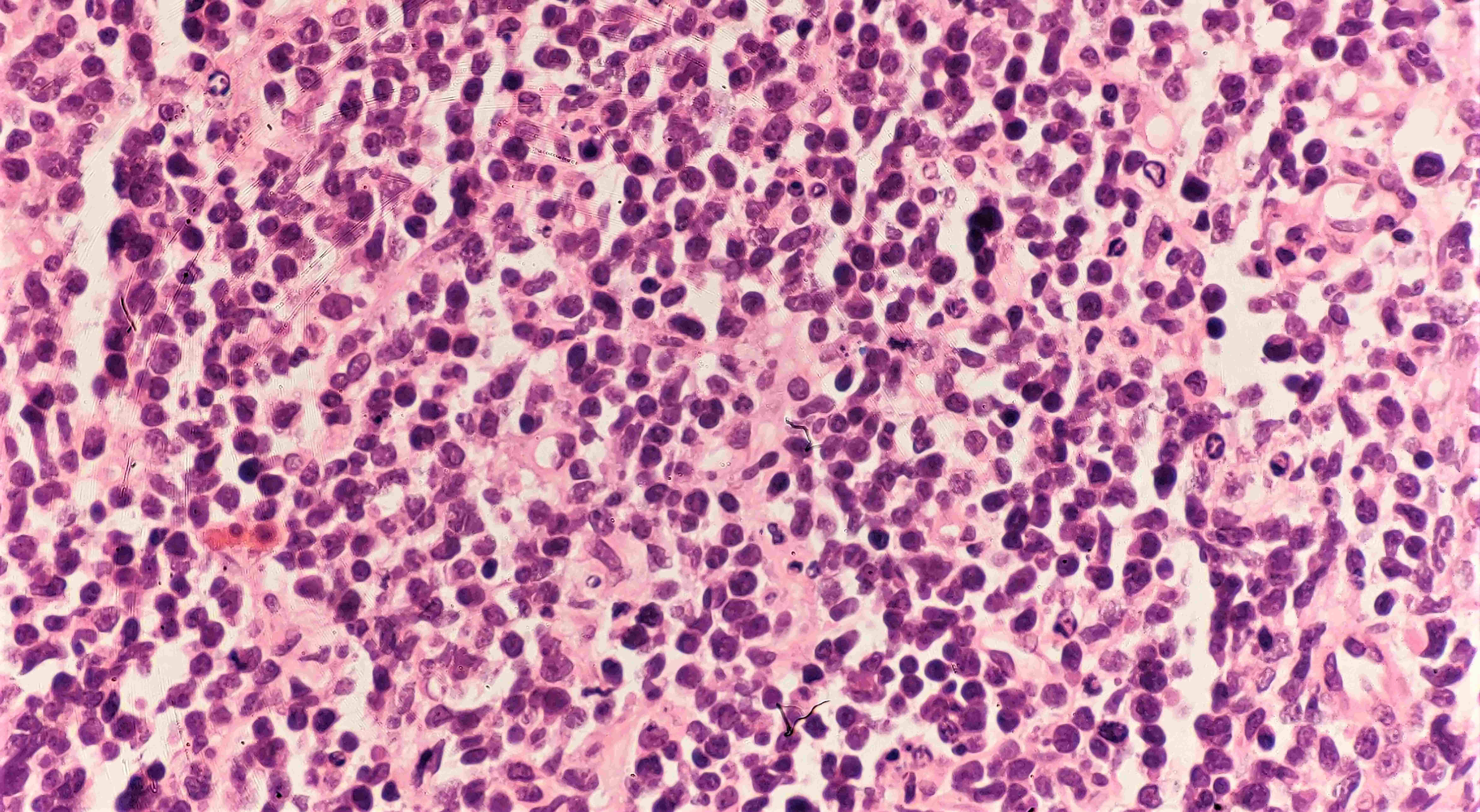 H &amp; E section of biopsy 
from maxillary mass showing tumor tissue comprising of medium to large size 
atypical lymphoid cells diffusely spread showing neoplastic cells.