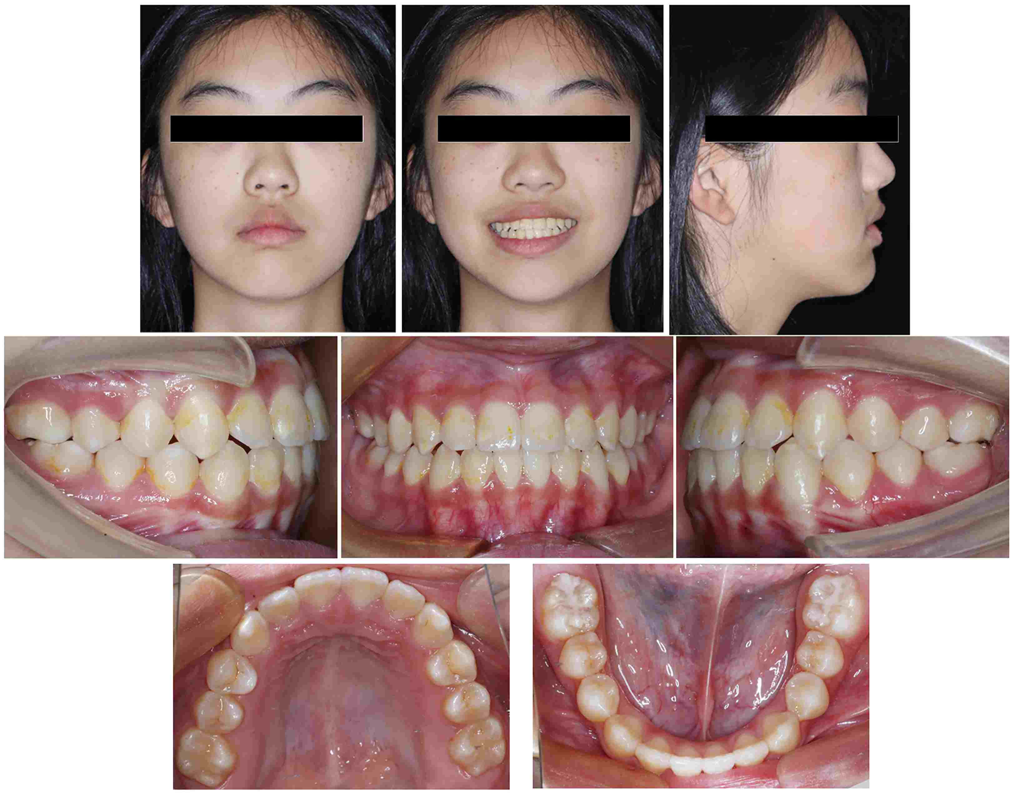 Facial and intraoral
photographs following the 2-year follow-up.