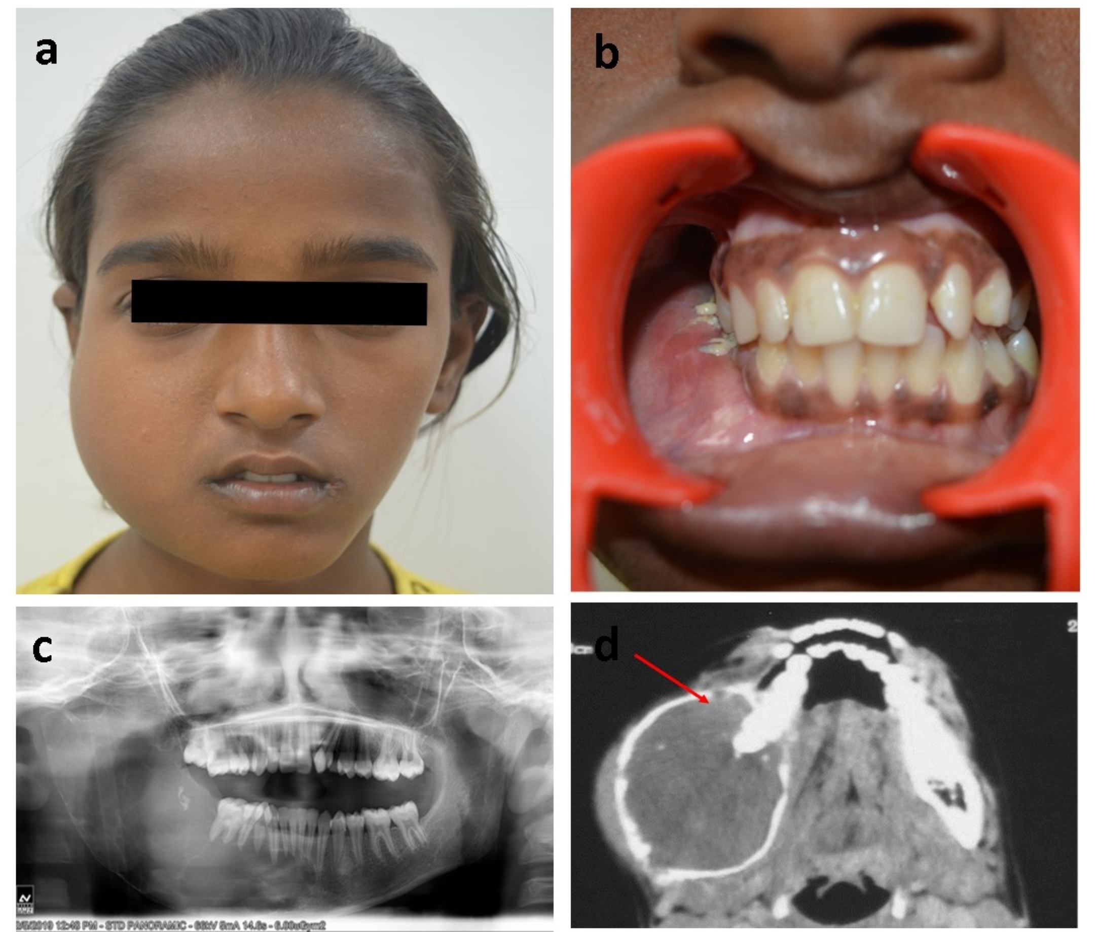 Preoperative clinical and radiographic presentation. a. 
Swelling in the right-side of face; b. Expansion and obliteration of lower buccal 
vestibule; c. OPG showing multi-locular radiolucent lesion involving entire 
right-side of mandible; d. CT axial section showing expansive lesion with 
cystic-solid component (arrow indicates solid component