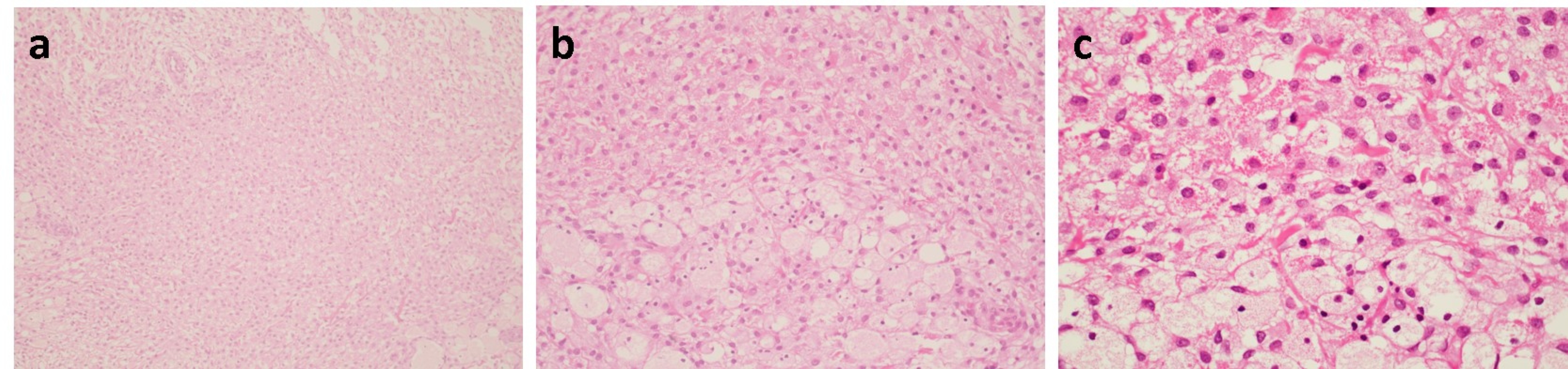 Hematoxylin and Eosin 
section of CGCOT showing sheets and lobules of large round to polygonal cells 
with abundant eosinophilic, granular cytoplasm, and eccentric, round-to-ovoid 
nuclei. (a. original magnification 4 ×; b. original magnification 20 
×; c. original magnification 40 ×).