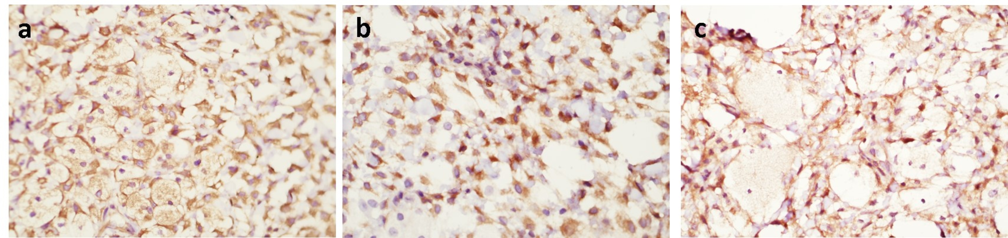 Immunohistochemistry of 
central granular cell odontogenic tumor (CGCOT) showing granular cells positive 
for the following markers in original magnification 40 ×. (a. Vimentin; 
b. BCL-2; c. Neuron specific enolase).