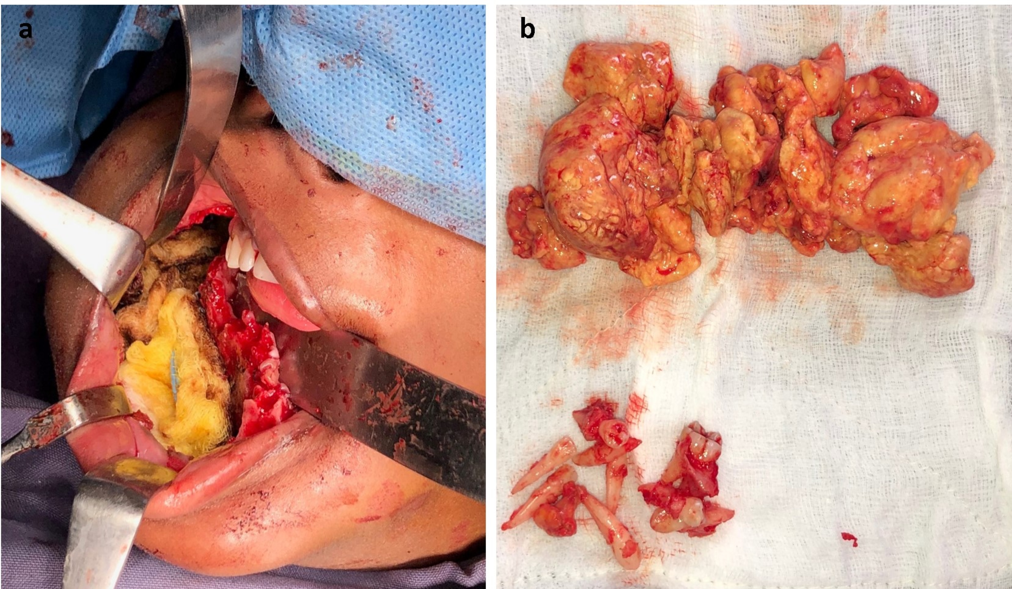 Surgical management. a. 
Intraoperative view of the bony cavity with Carnoy’s solution socked multiple 
gauze pieces; b. Excised tumor specimen (homogenous fatty appearance) and 
multiple extracted teeth.