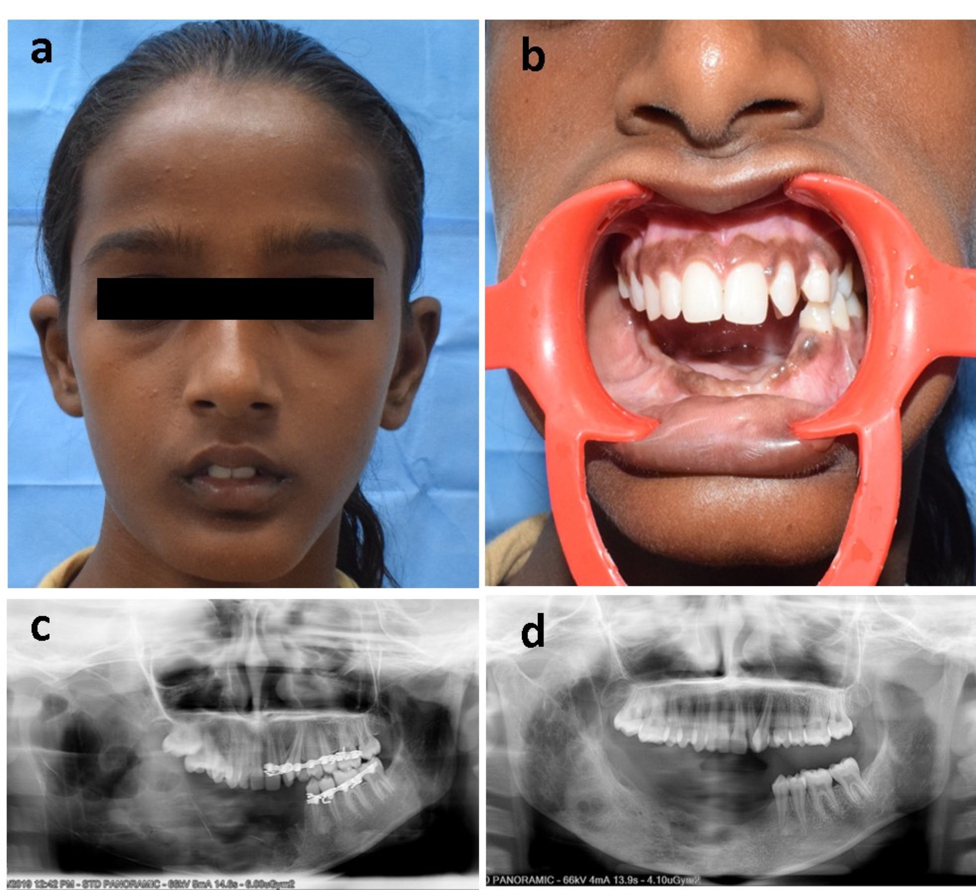 One year follow up. a. 
Grossly symmetrical face; b. satisfactory surgical site healing; c. Immediate 
postoperative orthopantomogram; d. One-year postoperative orthopantomogram 
reveals significant increase in radiopacity suggestive of adequate bone formation 
in the surgical site.