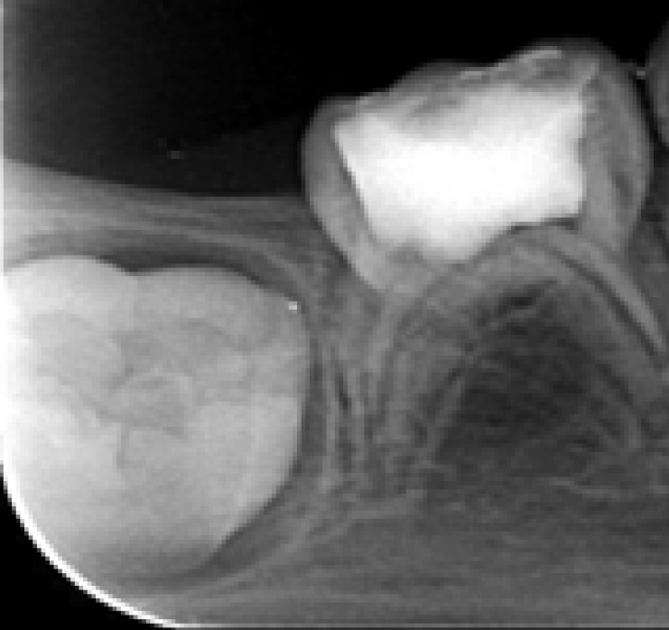 Distal guide as a substitute for distal shoe space maintainer: a case series study figure 7