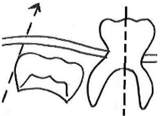 Distal guide as a substitute for distal shoe space maintainer: a case series study figure 8