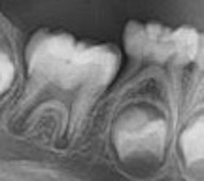 Distal guide as a substitute for distal shoe space maintainer: a case series study figure 11