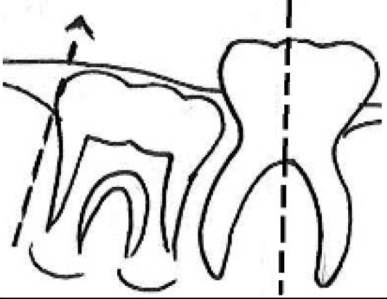 Distal guide as a substitute for distal shoe space maintainer: a case series study figure 12