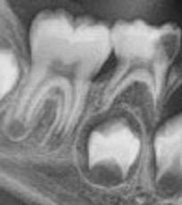 Distal guide as a substitute for distal shoe space maintainer: a case series study figure 13