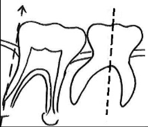 Distal guide as a substitute for distal shoe space maintainer: a case series study figure 14