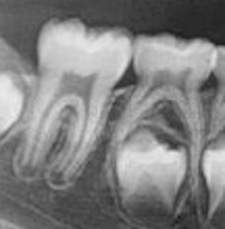 Distal guide as a substitute for distal shoe space maintainer: a case series study figure 15