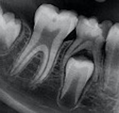 Distal guide as a substitute for distal shoe space maintainer: a case series study figure 17