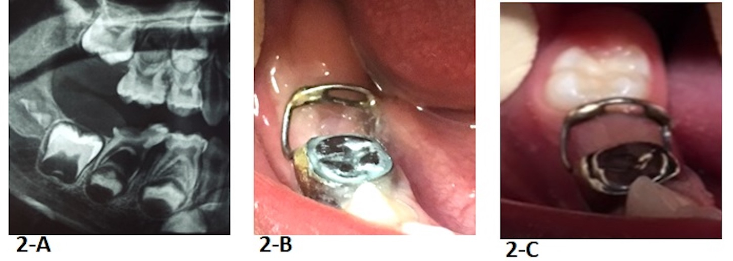 Clinical photos and 
radiograph of the first case. (A) Radiograph provided by the referring clinic. 
(B) After appliance cementation. (C) Two months after tooth 30 eruption.