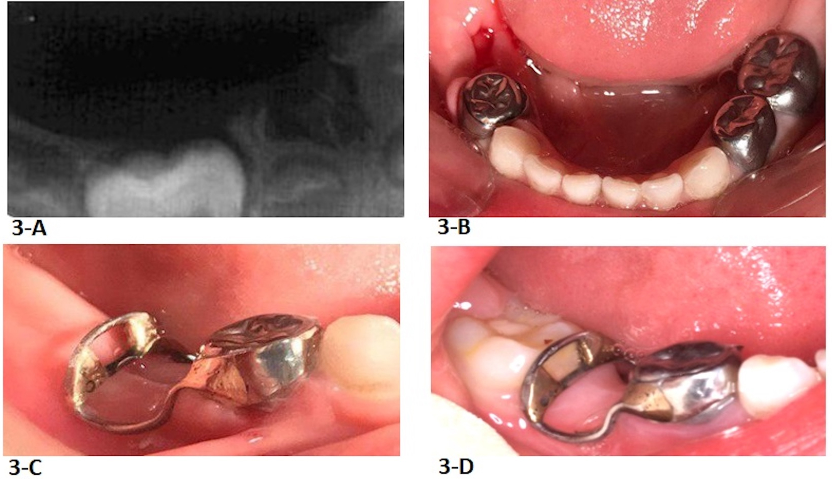 Clinical photos and 
radiograph of the second case. (A) Radiograph provided by the referring clinic. 
(B) Tooth S underwent pulpectomy and tooth T was extracted. (C) Distal Guide was 
delivered. (D) Photograph is taken two months after tooth 30 eruption.