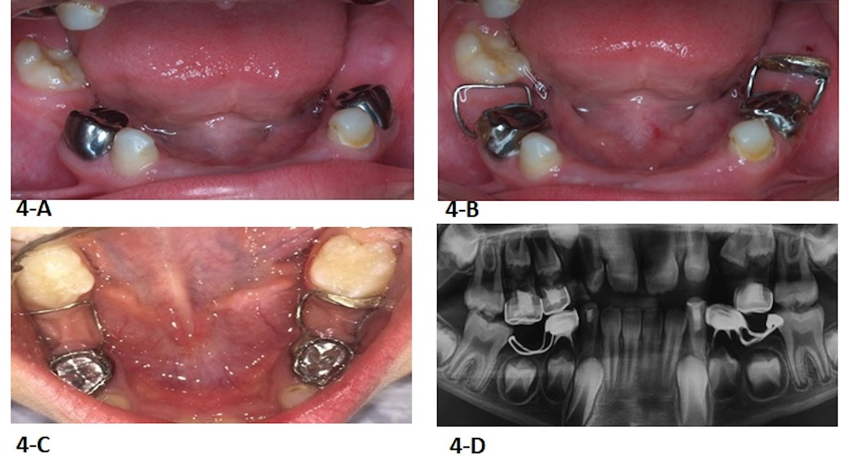 Clinical photos and 
radiograph of the third case. (A) Photograph taken in the first appointment. (B) 
Band &amp; loop and distal guide were delivered. (C) Tooth 19 eruption in its normal 
path. (D) Radiograph shows no mesially migration of tooth 19.
